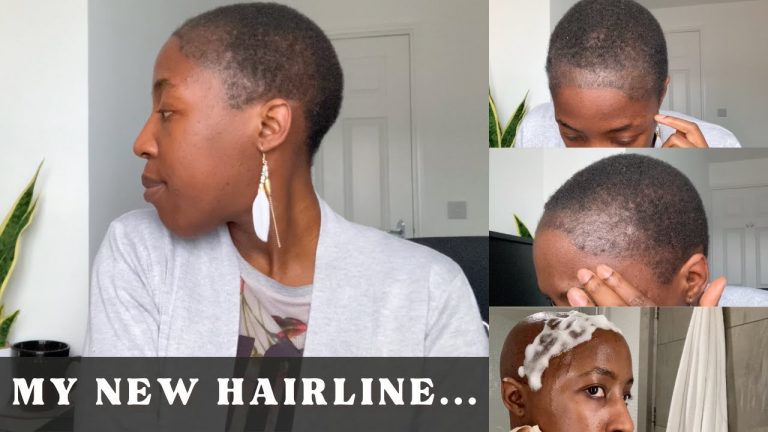 2 Months After Hair Transplant Update- Grey Hairs, Ingrowing Hairs, Products I’m Using, Vitamins…