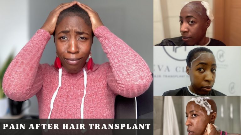 Pain During Hair Transplants- What It Felt Like… My Experience + Needle Free Anaesthesia